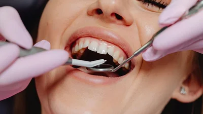 The Key Benefits of Teeth Whitening