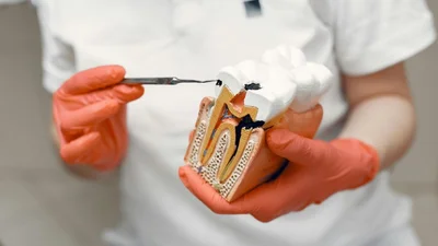 Can a Dentist Remove a Root Canal Tooth? What You Need to Know