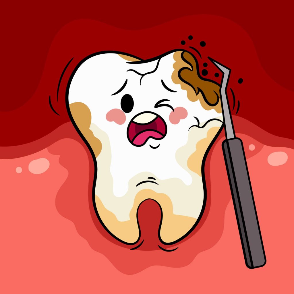 Causes of Tooth Decay