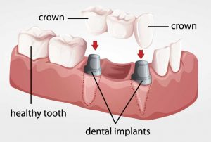 A dental bridge affixed to two dental implants, rather than teeth.