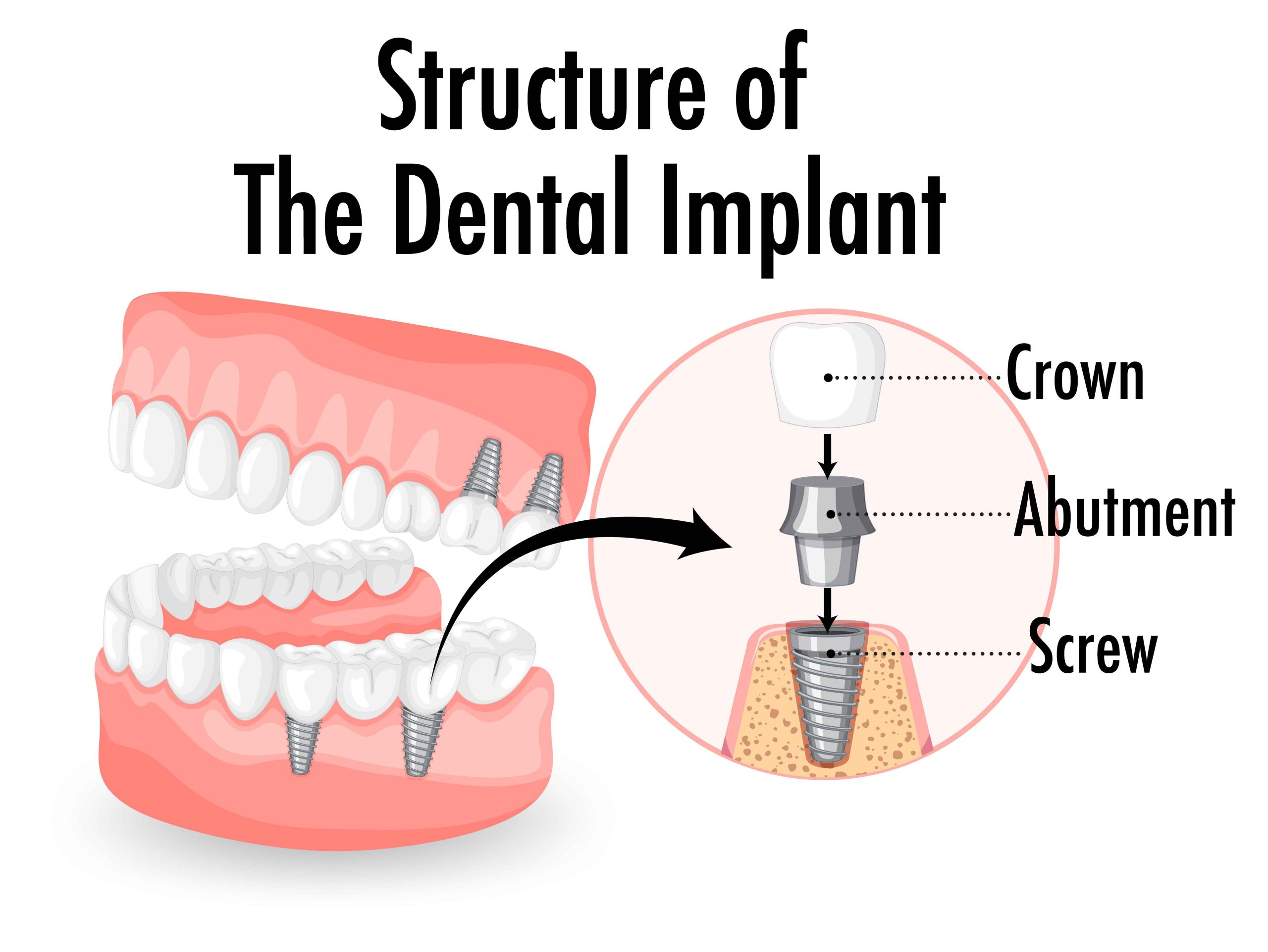 What is an Abutment in Dentistry
