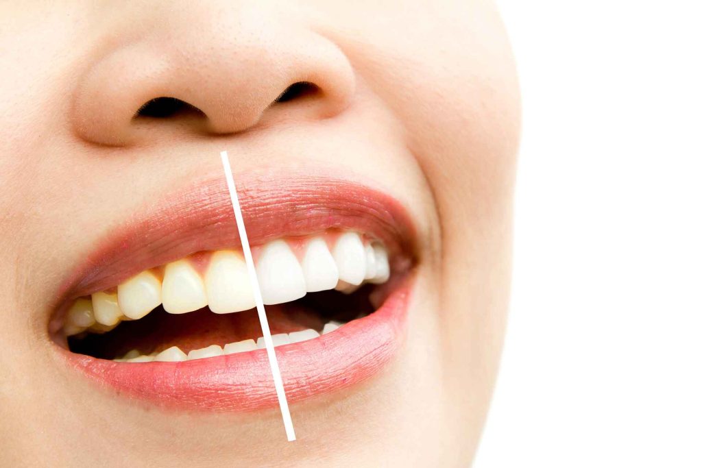 Close-up of woman receiving treatment to whiten yellow teeth at a dental office