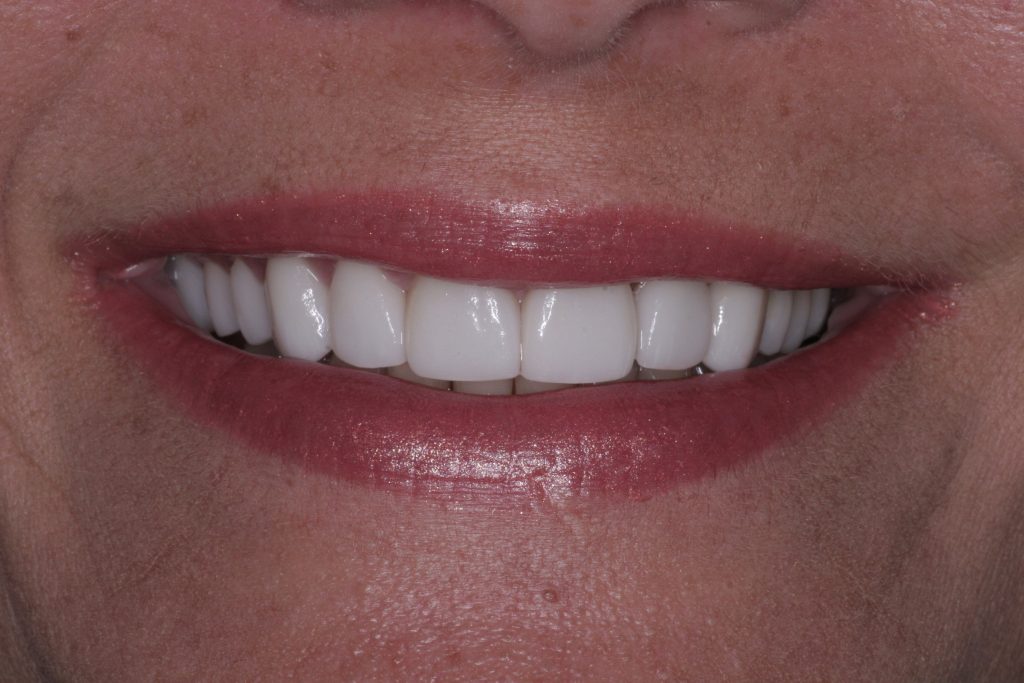 After Treatment by Dr. Schmidt