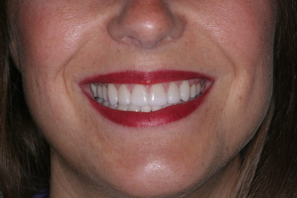 After Treatment By Dr. Schmidt