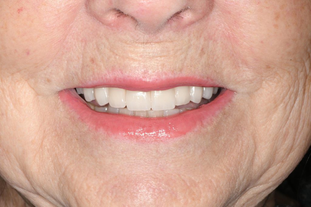 After Treatment by Dr. Schmidt