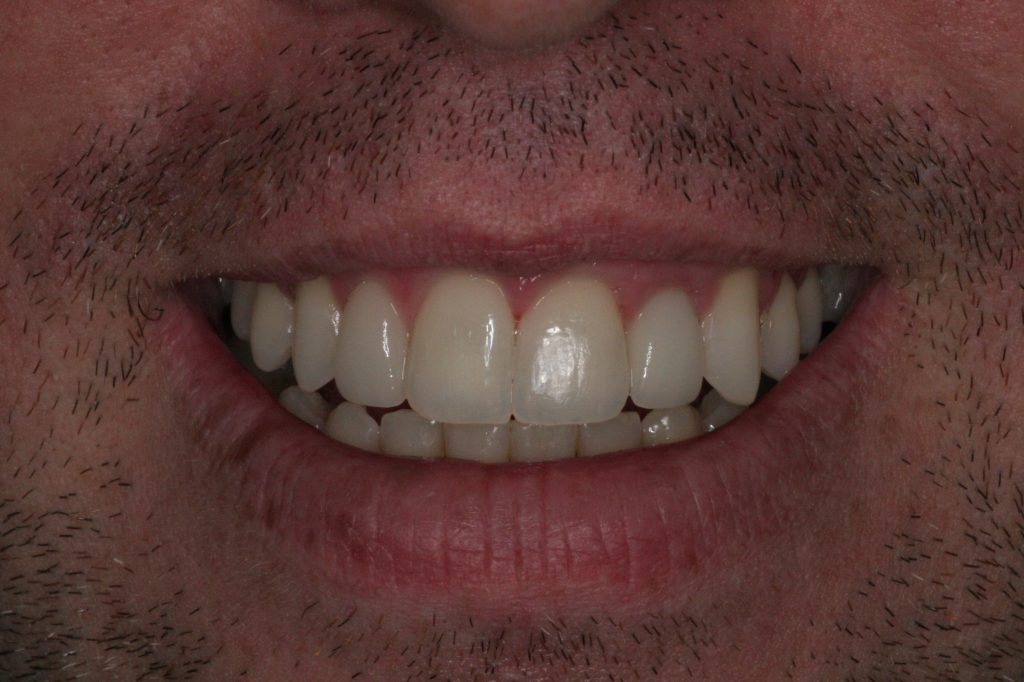 After Treatment by Dr. Schmidt