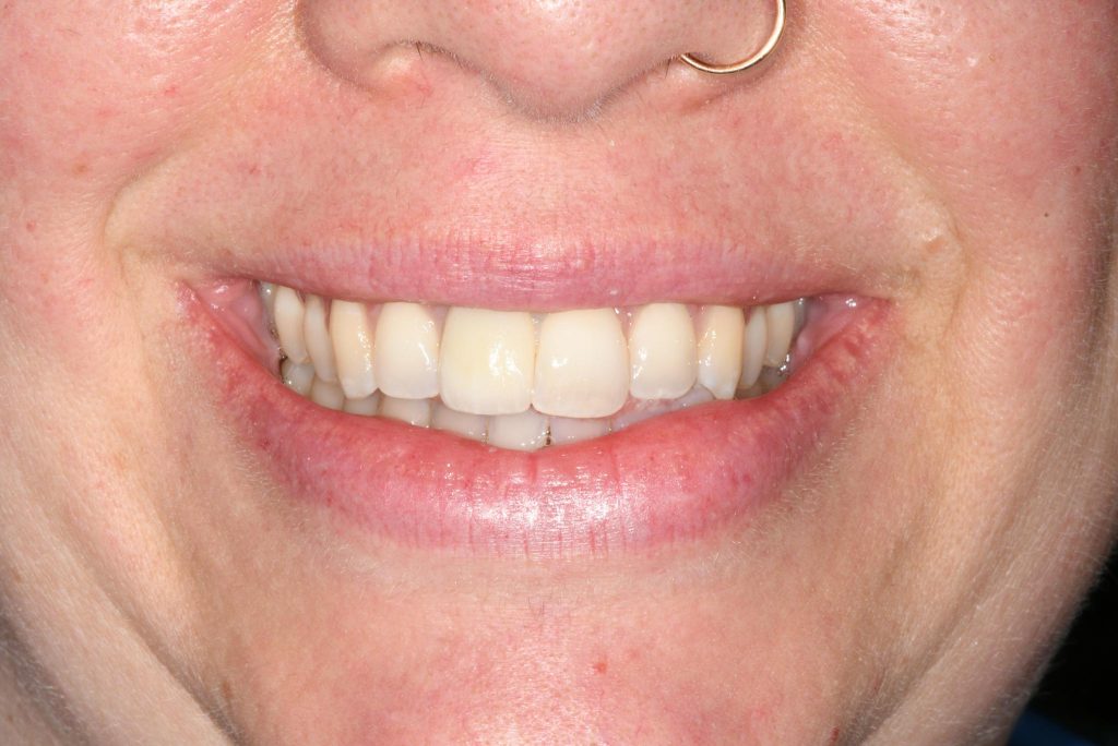 After Treatment By Dr. Schmidt