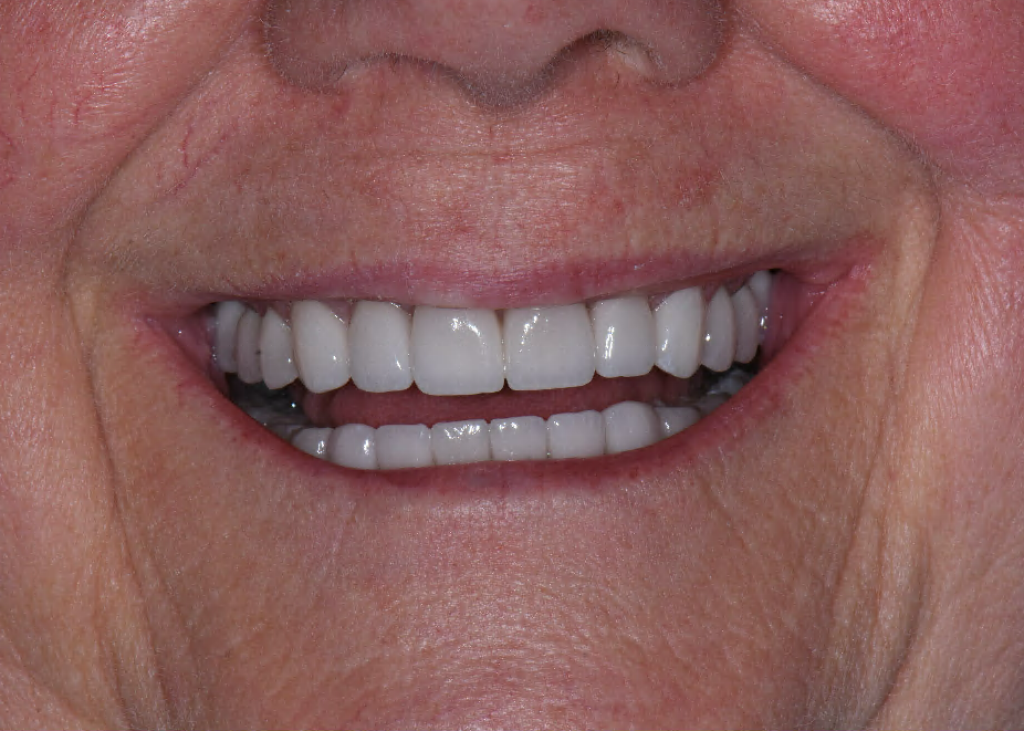 After Treatment By Dr. Schmidt