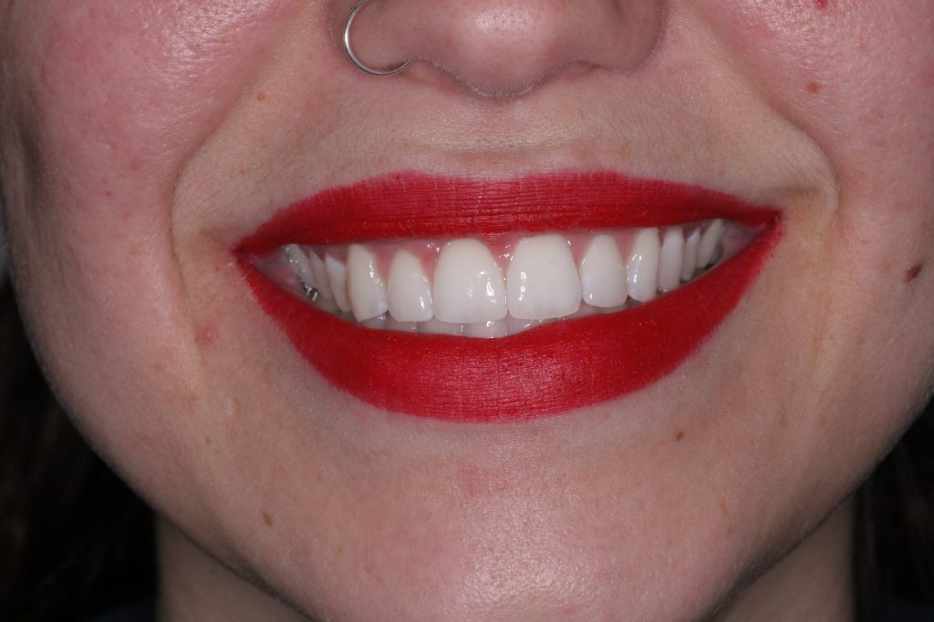 After Treatment by Dr. Schmidt