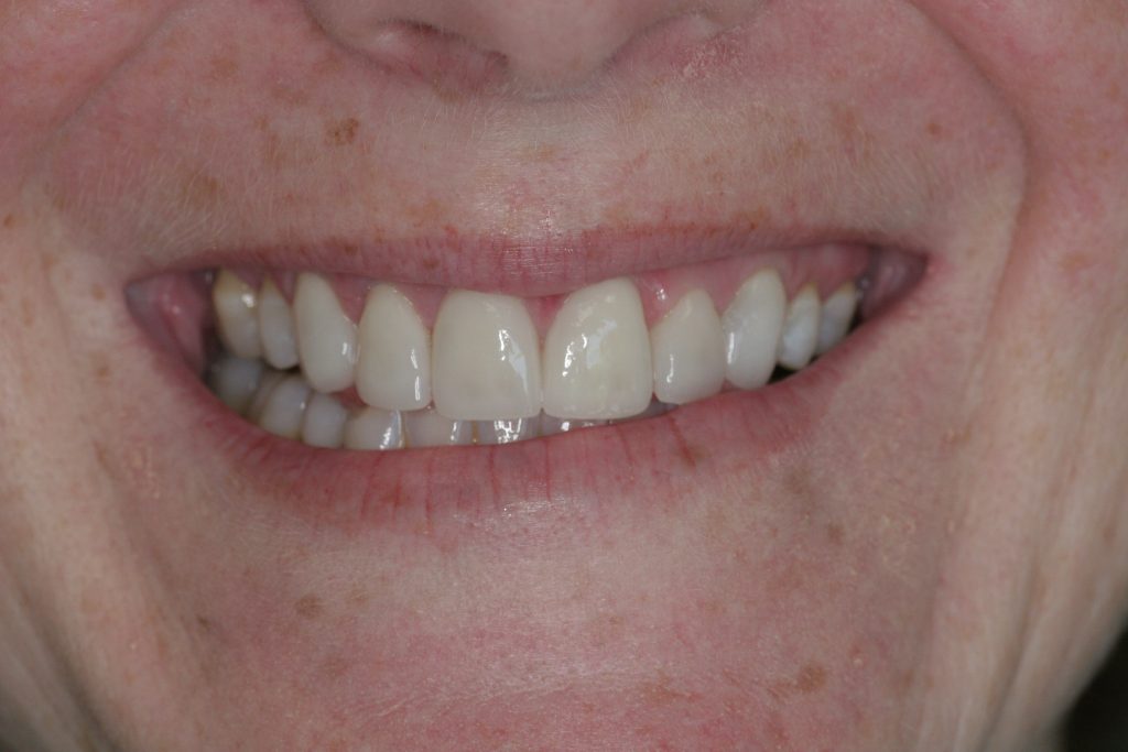 After Treatment By Dr. Schmidt