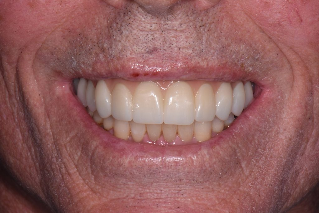 After Treatment By Dr. Schmidt