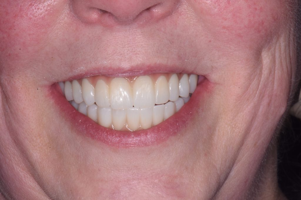 After Treatment by Dr. Schmidt