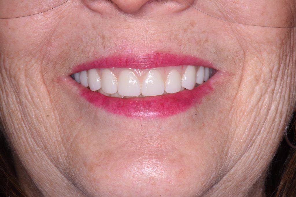 After Treatment By Dr. Schmidt