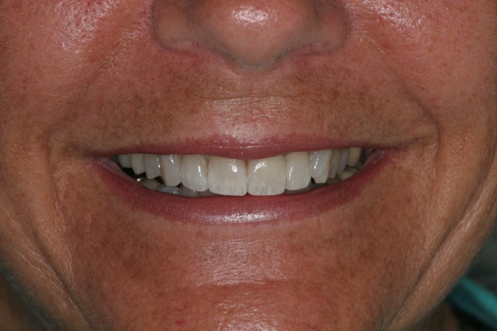 After Treatment by Dr. Schmidt