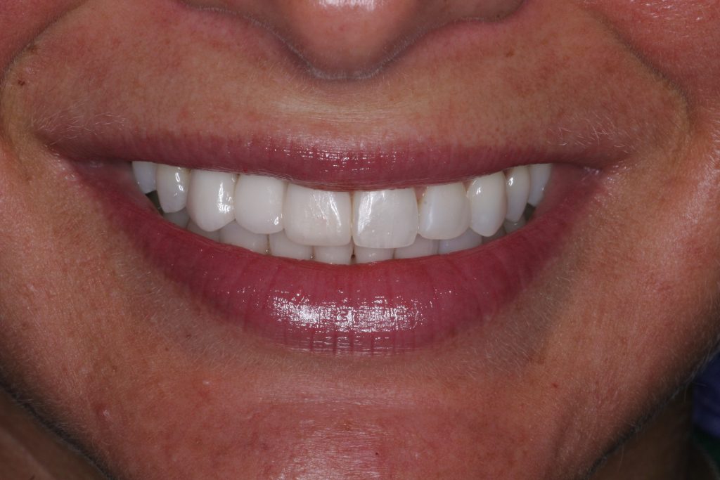After Treatment By Dr. Schmidt