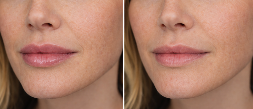 Lip fillers dissolving time