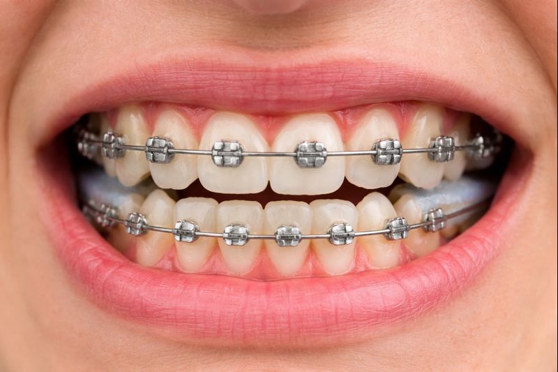 Grinding Teeth with Braces