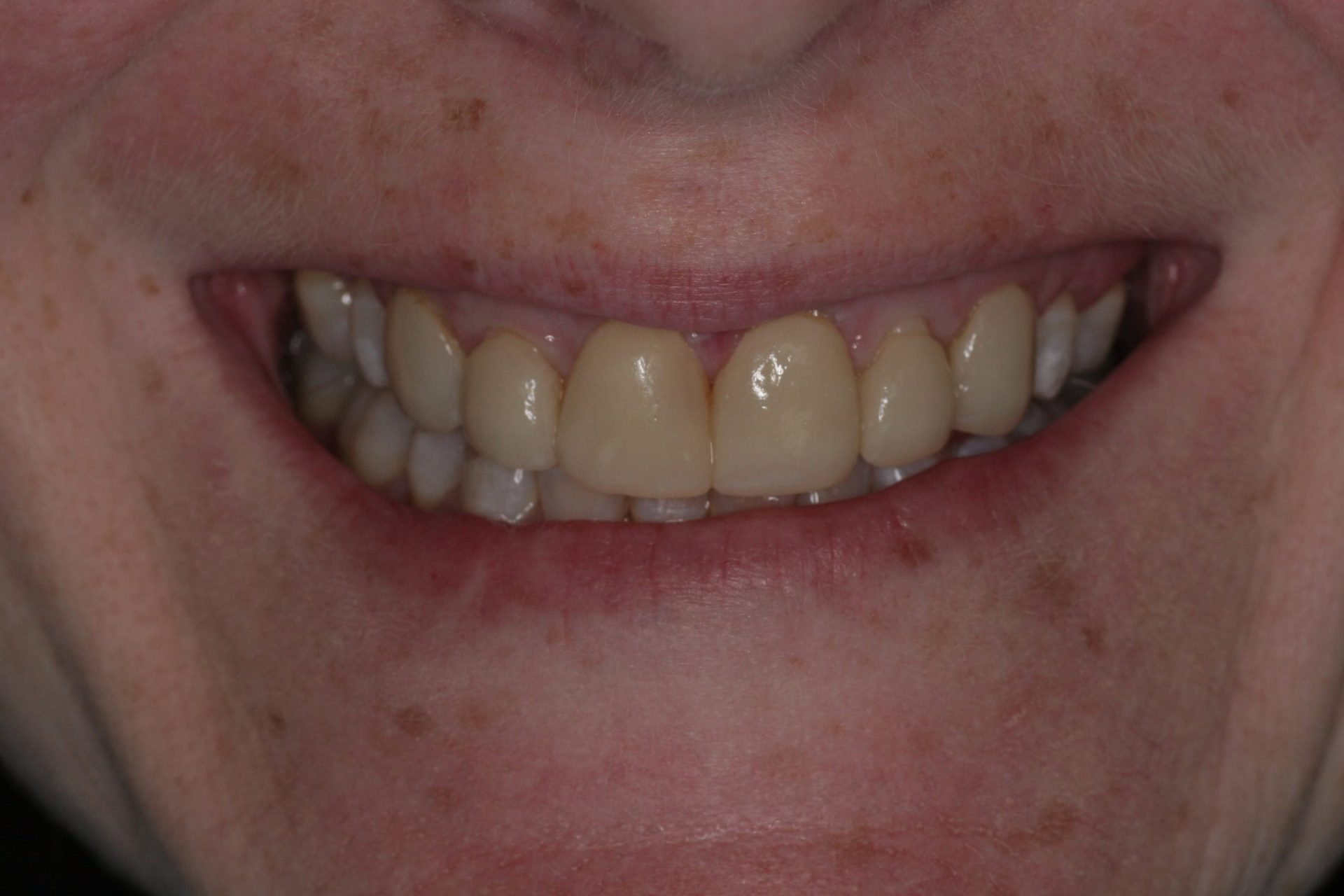 Before
